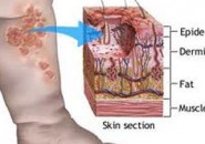 Cualquier persona puede padecer cáncer de piel— ¡Aprenda a proteger su piel!